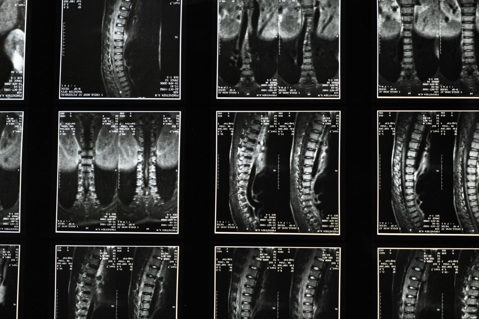 Comprehensive spinal x-ray images, ideal for medical studies and diagnostics.